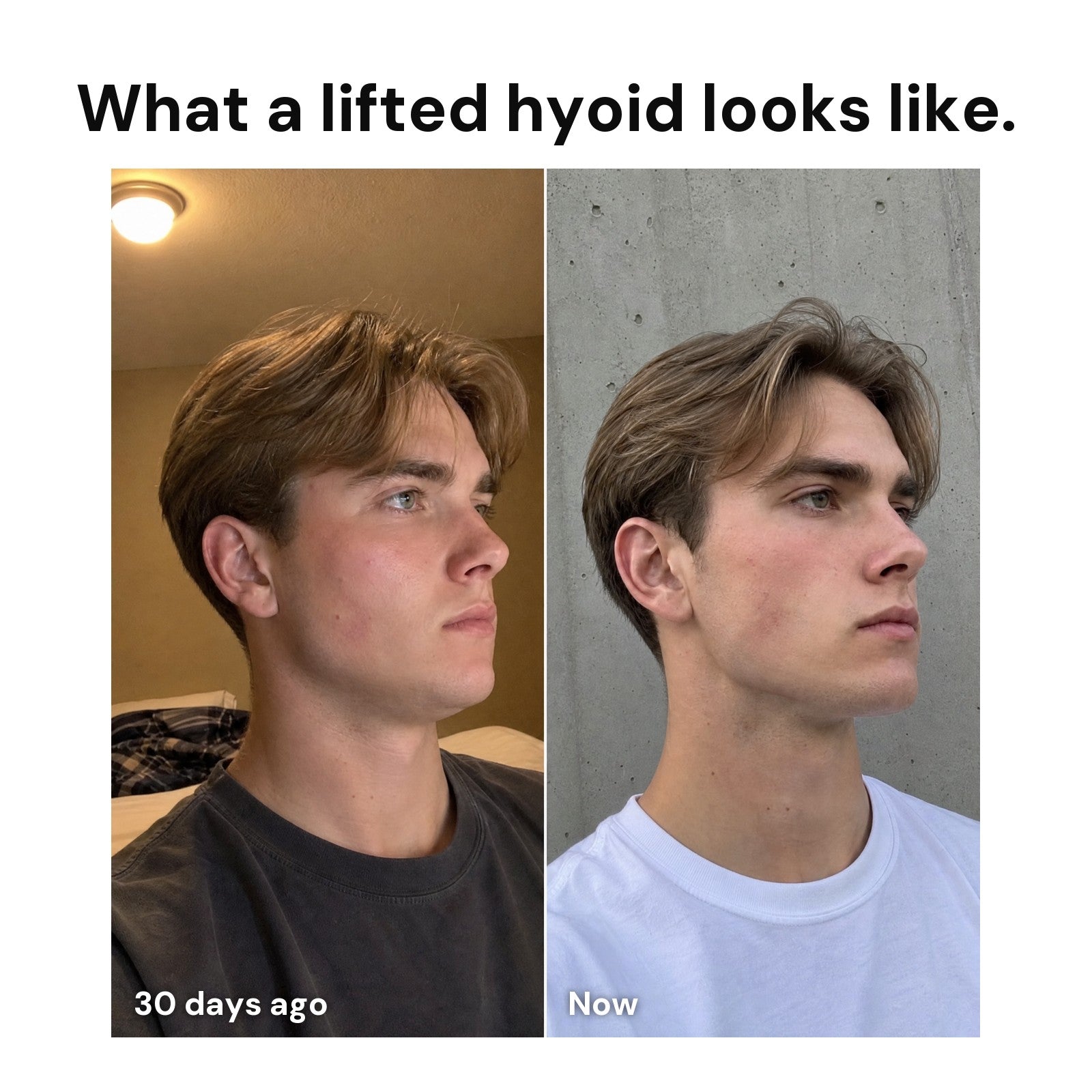What a lifted hyoid looks like: Daniel K. before and after 30 days of HYOIDR training
